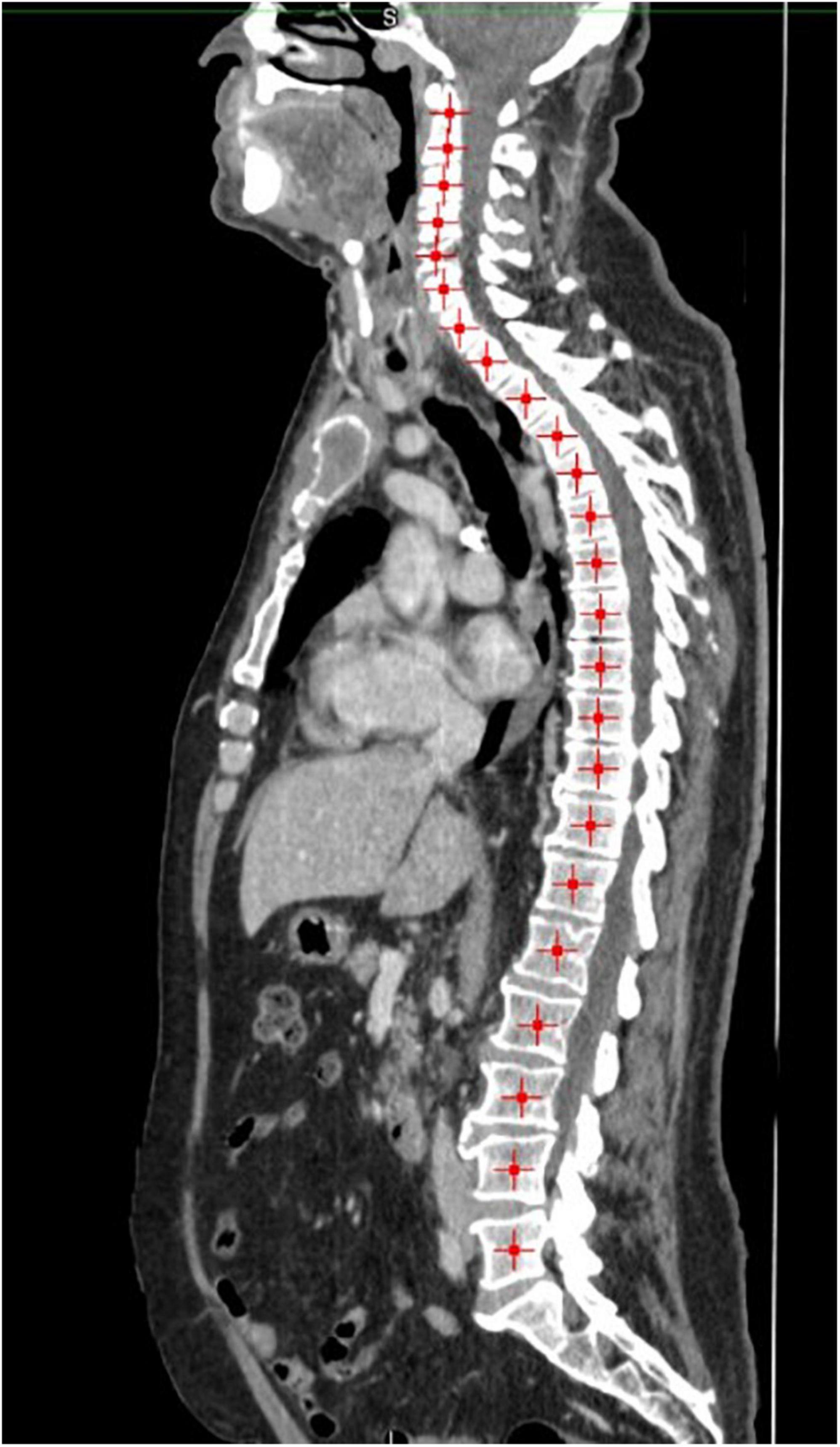 The correlation of muscle quantity and quality between all vertebra levels and level L3, measured with CT: An exploratory study